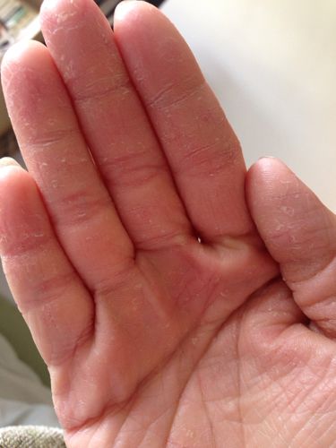 接触性皮炎是手浸在水基切削液中皮肤过敏的一种症状,有的轻度也有